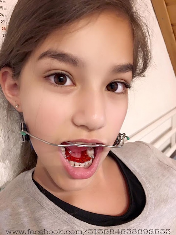 ยิ่งโตยิ่งสวย!! มาดูวิธีการจัดฟันของ “น้องนาทัชชา” ที่แปลกมาก
