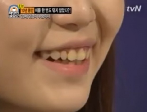 อยู่ไปได้ไง? สาวเกาหลีไม่ได้แปรงฟันมา 10 ปี!! สีมาขนาดนี้ แล้วกลิ่นจะขนาดไหน!!