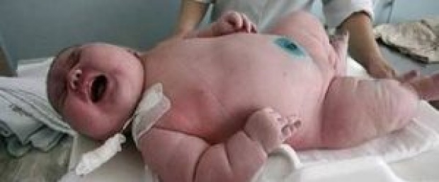 ทีมแพทย์ระดมพลทำคลอด “สาวร่างยักษ์” น้ำหนัก 250 กิโล!! พีคหนัก!! เมื่อเห็นทารก แทบไม่เชื่อสายตา
