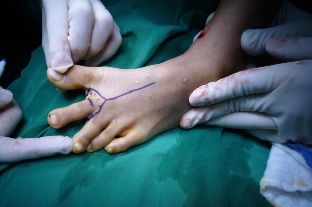 สุดยอดมาก! อาจารย์หมอเเชร์ประสบการณ์ เด็กนิ้วโป้งขาด ใช้เทคนิคทดเเทน เอานิ้วเท้าทำนิ้วโป้ง