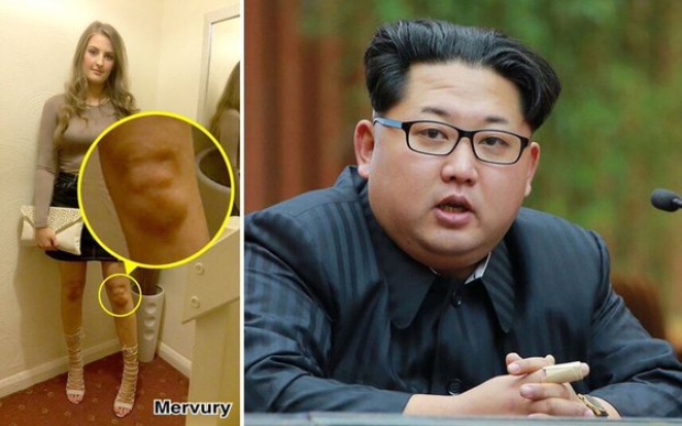 เป็นไปได้ยังไง!? หัวเข่าของผู้หญิงคนนี้ เหมือนหน้า’ผู้นำเกาหลีเหนือ’เปี๊ยบ!