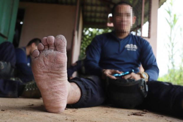 ตชด.พลร่ม กองร้อยกู้ชีพ 13 ชีวิต ติดถ้ำหลวง เท้าติดเชื้อ เกิดจากการใส่รองเท้าลุยน้ำเป็นเวลานาน