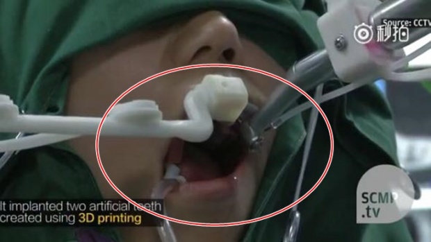 วงการแพทย์สะเทือน!! หุ่นยนต์ทันตกรรม สามารถ ปลูกรากฟัน สำเร็จครั้งแรกของโลก! 
