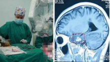 หนุ่มปวดหัวนาน 2ปี คิดว่า เป็น ไมเกรน สุดท้ายให้หมอตรวจ พบบางอย่างอยู่ในสมอง!! 