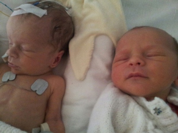   ทารกน้อยกำมือฝาแฝดป่วยหนัก เคียงข้างคอยดูแลตั้งแต่เกิดจนโต ไม่ทิ้งกันไปไหน!!