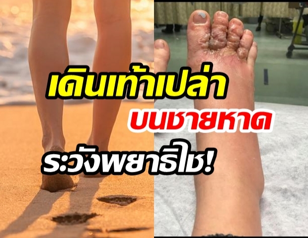 ระวังพยาธิ! คนที่ชอบ “เดินเท้าเปล่าบนชายหาด”  ระวังโดน  “พยาธิปากขอ” ไชที่เท้า 