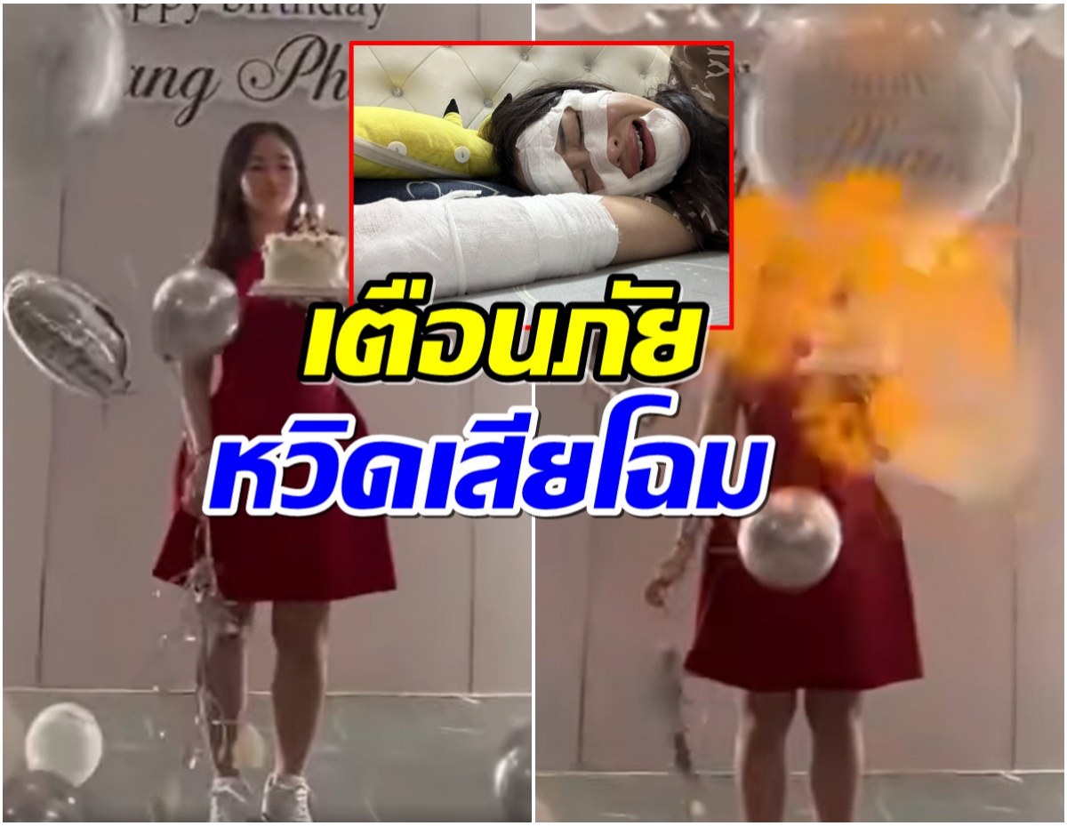 สาวโพสต์เตือนภัย! ลูกโป่งวันเกิดระเบิด หวิดหน้าเสียโฉม