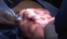 สาวป่วยใบหน้าปูดที่ถูกคน “รังเกียจ” และ “กลั่นแกล้ง” ล่าสุดตัดสินใจผ่าตัดศัลยกรรมแล้ว