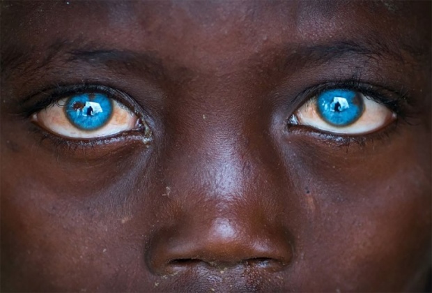 เปิดชีวิตเด็กชายแอฟริกัน เกิดมาพร้อม “ตาสีฟ้า” แต่ชีวิตไม่ได้สวยงามเหมือน “นัยน์ตา” !!