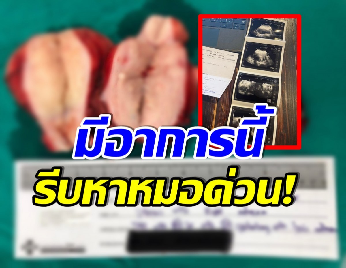 สาวโพสต์อุทาหรณ์! เนื้องอกในมดลูก-ช๊อคโกแลตซีสท์ เหมือนมีเด็กในท้อง!