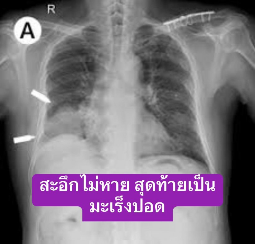 หมั่นสังเกตตัวเอง!! อาการสะอึกไม่หายอาจเจอมะเร็งปอดได้