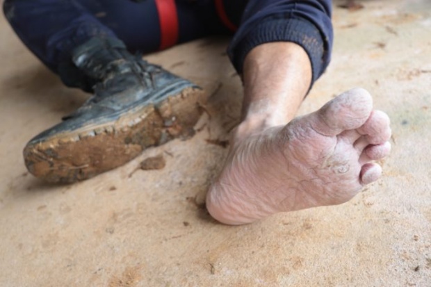 ตชด.พลร่ม กองร้อยกู้ชีพ 13 ชีวิต ติดถ้ำหลวง เท้าติดเชื้อ เกิดจากการใส่รองเท้าลุยน้ำเป็นเวลานาน
