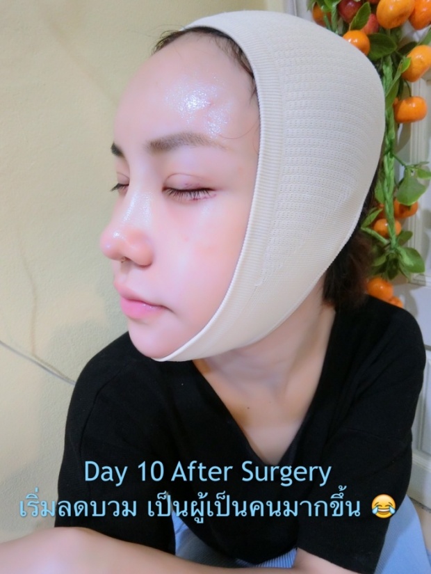 แชร์สนั่น!! สาวไทย”ลงทุนรีวิว”ทำศัลยกรรมที่เกาหลี..ตั้งแต่วันแรกจนวันสุดท้าย!! (ภาพโหด)