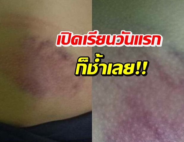 เปิดเรียนวันแรกก็เรื่องใหญ่เลย! คุณครูโหด ตีเด็กจนช้ำหนักมาก