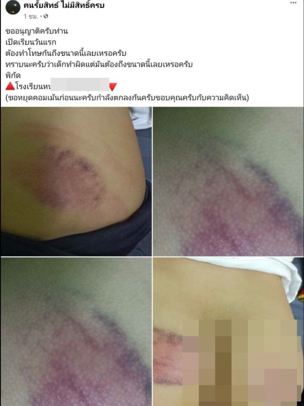 เปิดเรียนวันแรกก็เรื่องใหญ่เลย! คุณครูโหด ตีเด็กจนช้ำหนักมาก