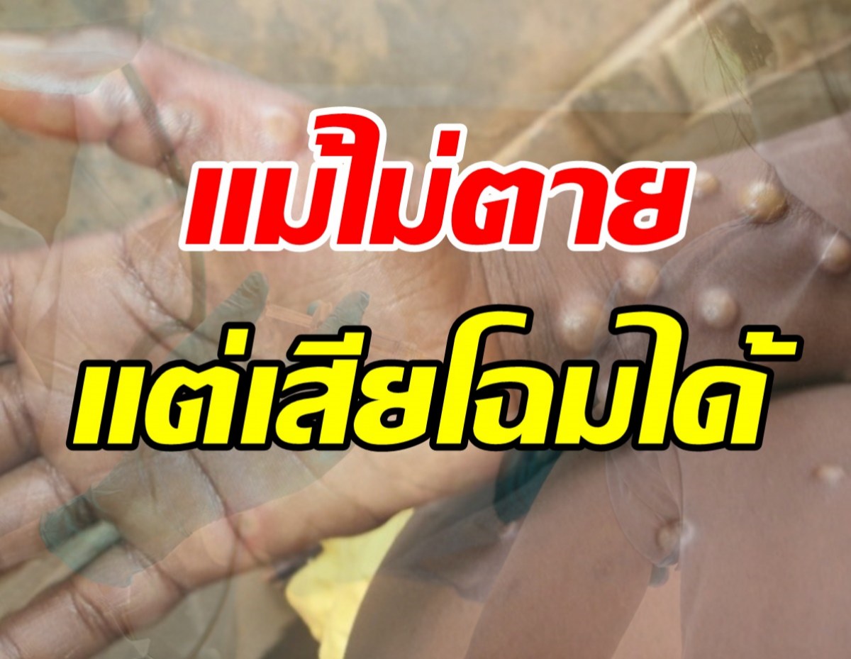 หมอเตือนฝีดาษลิงไม่ตายแต่เสียโฉมได้ คนไทยต่ำกว่า42ปีไม่มีภูมิคุ้มกัน