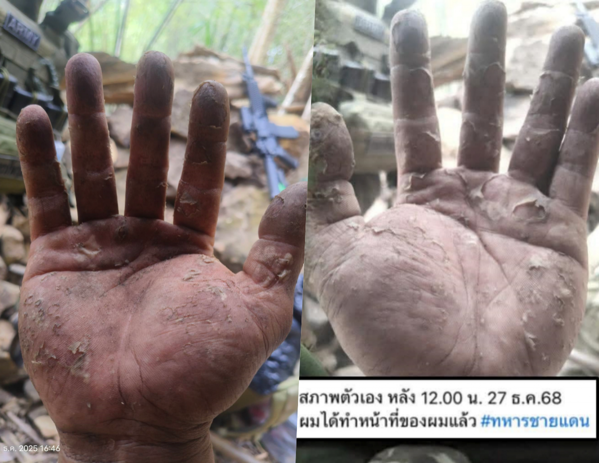 เห็นแล้วจุก! เผยสภาพมือทหารกล้า หลังเฝ้าชายแดนช่องอานม้า 20 วันรวด