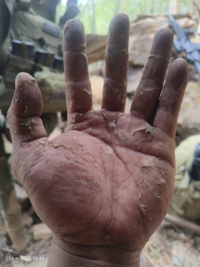 เห็นแล้วจุก! เผยสภาพมือทหารกล้า หลังเฝ้าชายแดนช่องอานม้า 20 วันรวด