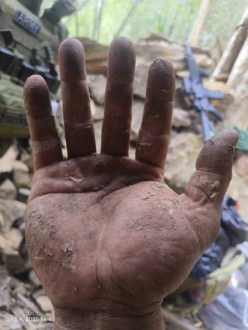 เห็นแล้วจุก! เผยสภาพมือทหารกล้า หลังเฝ้าชายแดนช่องอานม้า 20 วันรวด