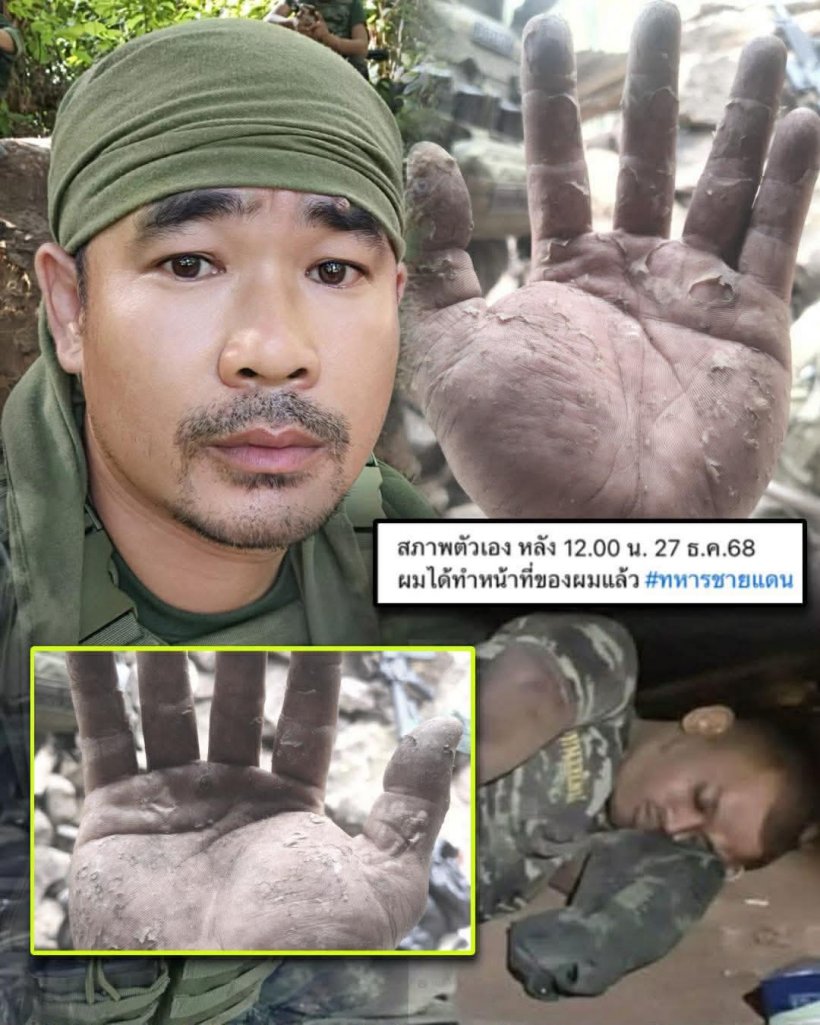 เห็นแล้วจุก! เผยสภาพมือทหารกล้า หลังเฝ้าชายแดนช่องอานม้า 20 วันรวด