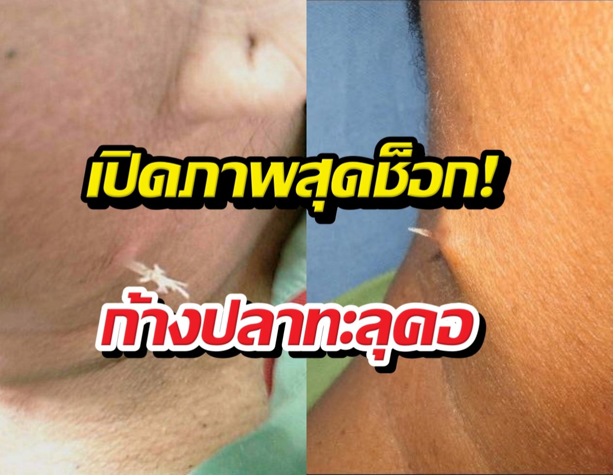 เห็นแล้วต้องขนลุก!ก้างติดคออย่าปล่อยไว้นาน อันตรายมาก!