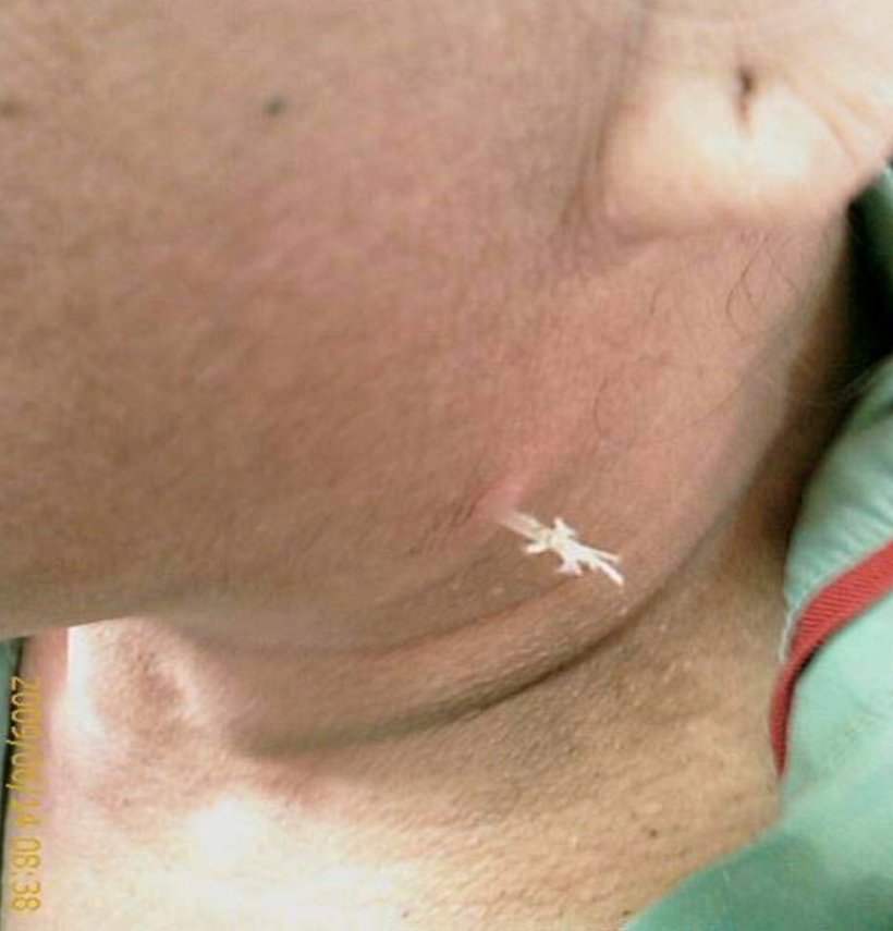 เห็นแล้วต้องขนลุก!ก้างติดคออย่าปล่อยไว้นาน อันตรายมาก!