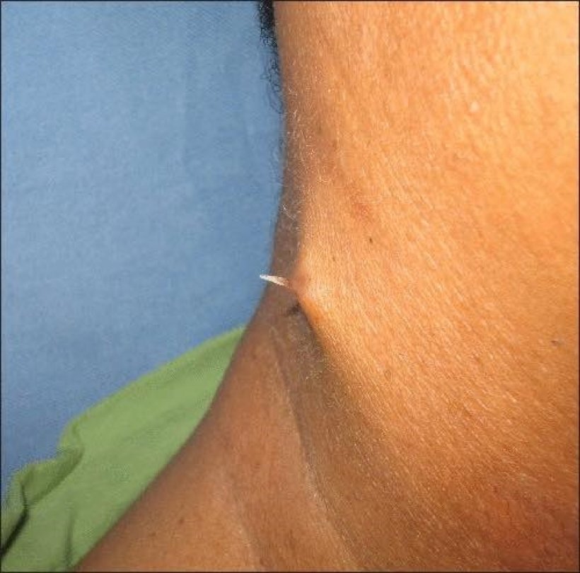 เห็นแล้วต้องขนลุก!ก้างติดคออย่าปล่อยไว้นาน อันตรายมาก!