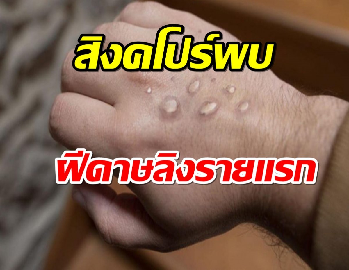 ใกล้เข้ามาแล้ว!! สิงคโปร์พบผู้ติดเชื้อฝีดาษลิงรายแรก