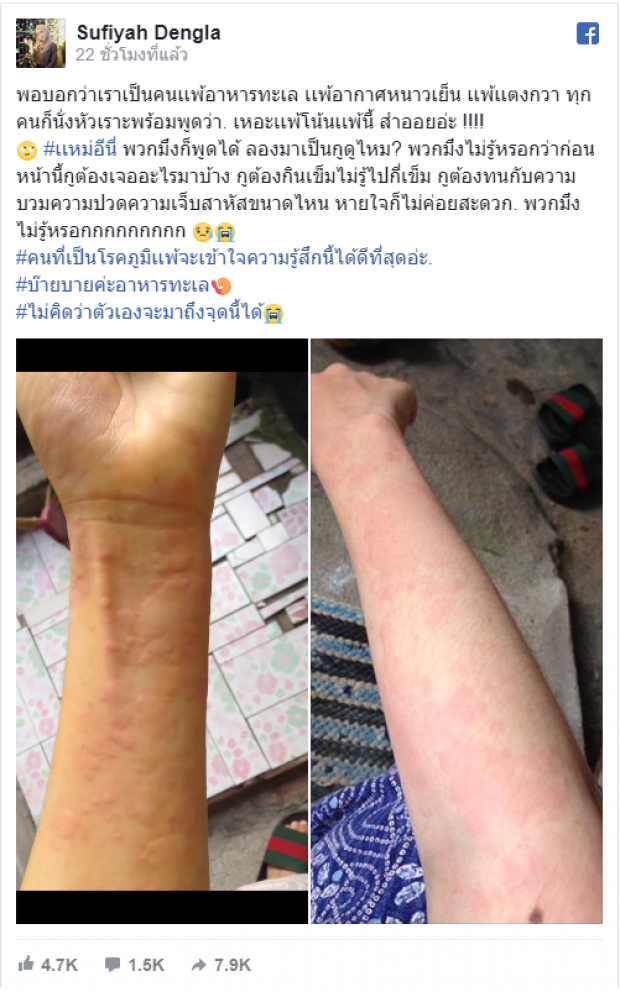 สาวระบาย! แพ้อาหารทะเล แตงกวา แต่ถูกด่าสำออย ชี้คนเป็นภูมิแพ้จะเข้าใจดี (คลิป)