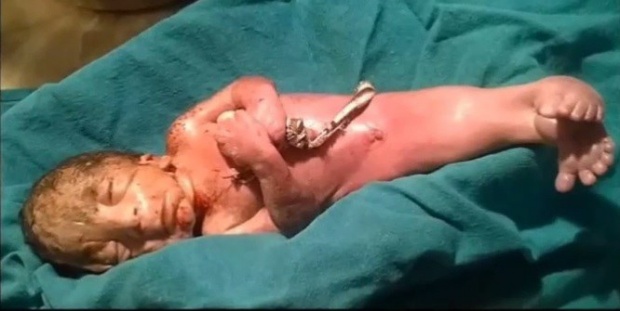 แพทย์ช็อก ทำคลอดได้ทารกออกมาคล้าย “นางเงือก”