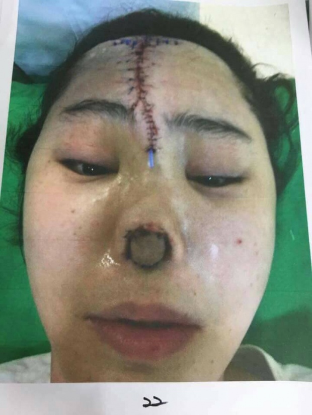 หวีดสยอง!!ศัลยฯเกาหลี พังพินาศ สาวจมูกเน่าหน้าพังผ่ากลางร่องถึงหน้าผาก(มีภาพ)