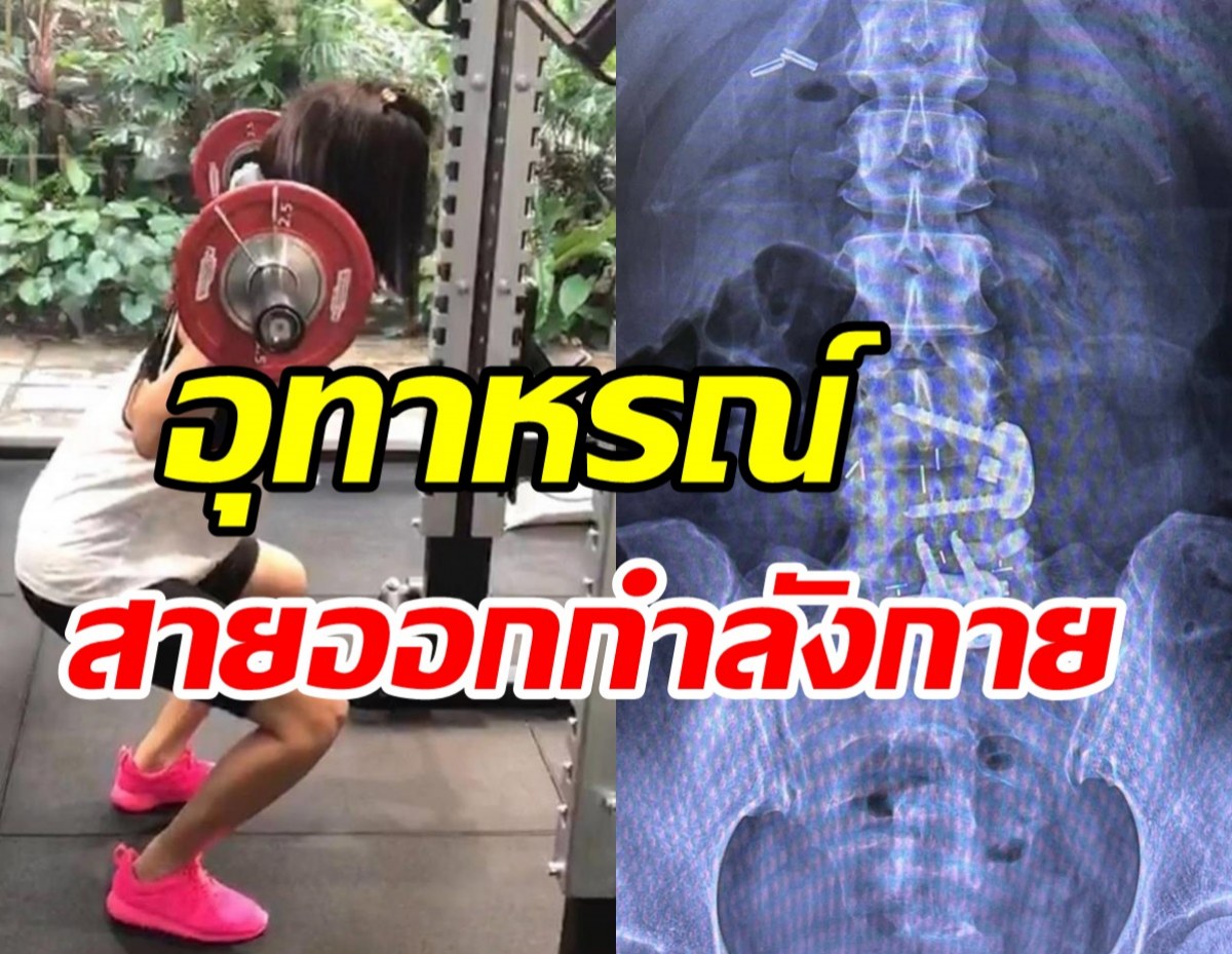 อุทาหรณ์สายออกกำลังกาย! เซเลบสาวตระกูลภิรมย์ภักดีต้องผ่าตัดใส่เหล็ก