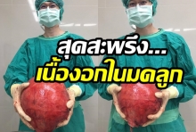 ช็อค!!เนื้องอกในมดลูก ขนาดใหญ่เท่าลูกบาส ในผู้ป่วยวัย 52 ปี