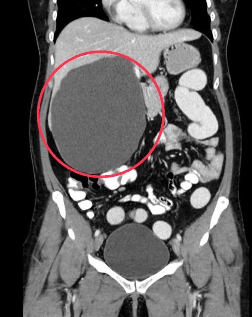 เช็คตัวเองด่วน! ท้องอืดนาน 1 ปี ไปหาหมอ เเทบช็อกเมื่อเจอสิ่งนี้